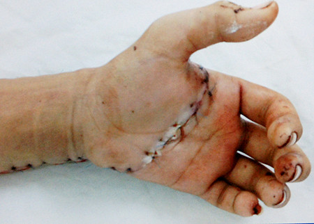 Trước đây, việc nối lại những phần đứt rời thường rất khó khăn thì ngày nay người ta có thể nối lại những bàn tay, ngón tay, dương vật, da đầu…, đứt rời với tỉ lệ thành công cao.