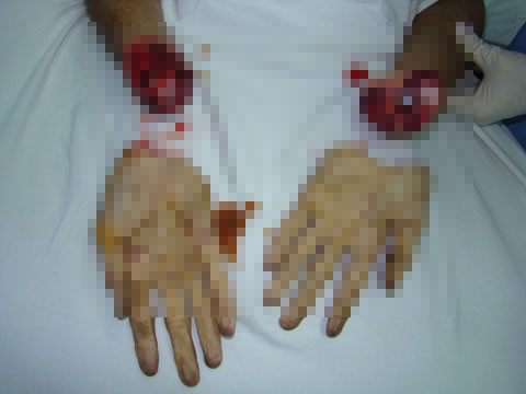 Theo các bác sĩ, với những trường hợp bị tai nạn như trên, khâu sơ cứu là rất quan trọng. Trường hợp có tổn thương đứt rời, nên cho phần đứt rời vào túi nilon sạch, buộc kín lại, nếu có thể thì bọc trong miếng gạc.