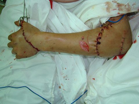 Với phần da còn dính, không nên cắt rời ra, kể cả trường hợp gần như đứt rời hoàn toàn. Thay vào đó dùng gạc băng lại, đặt túi đá bên cạnh để giữ nhiệt độ tương đối lạnh, tránh đặt đá trực tiếp lên vết thương. Chú ý, không dùng banh kẹp mạch máu, vì có thể gây nát đầu mạch máu, rất khó khi nối.