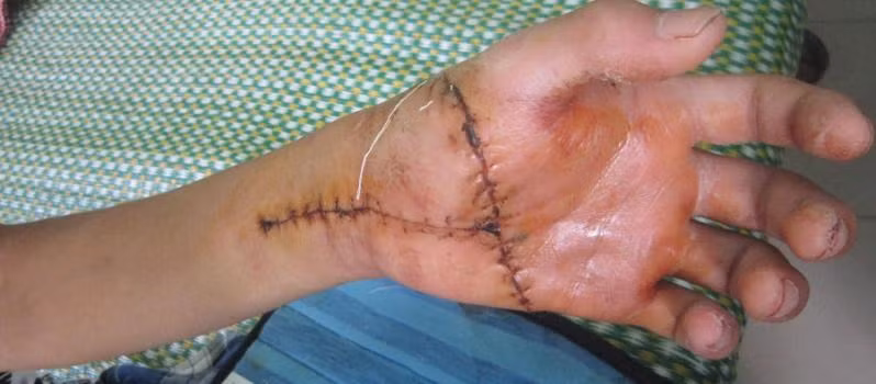 Sau đó lại đặt vào một túi nilon khác đựng nước, buộc kín bỏ vào thùng đá, giữ ở nhiệt độ 4-10 độ C. Tránh để phần này tiếp tiếp xúc trực tiếp với đá lạnh gây bỏng lạnh, dễ làm mạch máu và dây thần kinh bị hỏng.