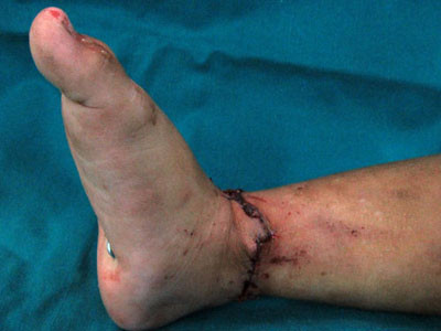 Những trường hợp đứt rời ở vị trí bàn tay và ngón tay có thể nối lại, khôi phục hình thức và chức năng các bộ phận này. Tuy vậy, những ca phẫu thuật như trên phụ thuộc rất nhiều vào công đoạn bảo quản phần cơ thể đứt rời trước đó.