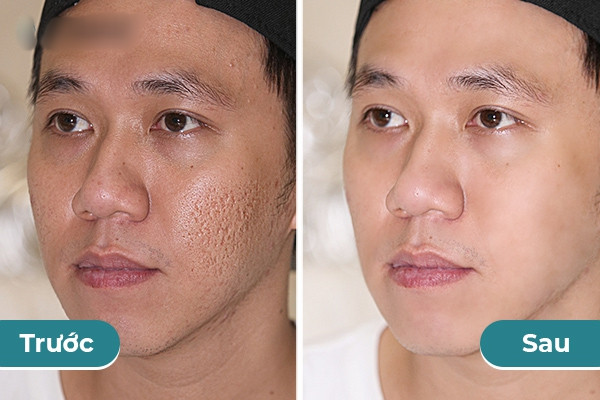 Từng bị chê xấu tan nát, Anh Đức "dao kéo" những gì để lột xác? - Hình 2 Tung bi che xau tan nat, Anh Duc