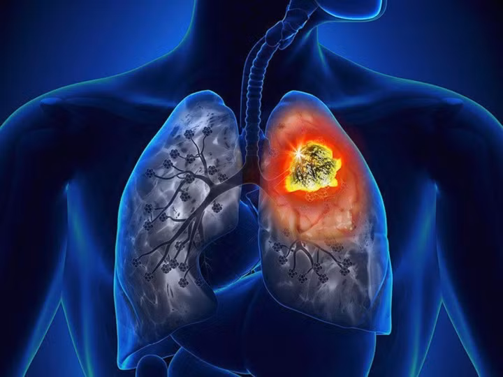 Dau hieu canh bao som 7 benh ung thu nguy hiem ban can nho