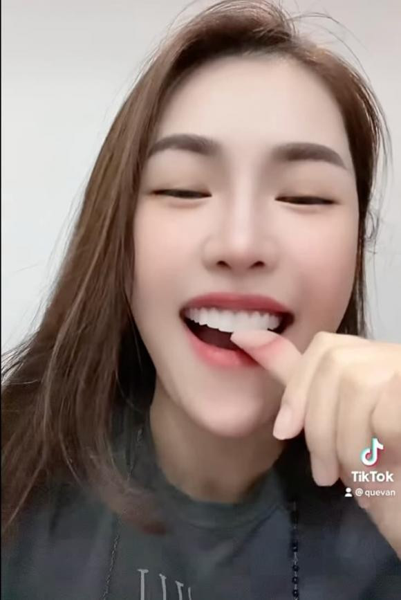 Quế Vân rụng răng sứ trông "dở khóc dở cười" - Hình 5 Que Van rung rang su trong