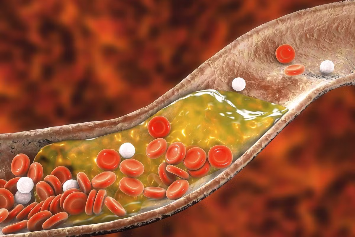 Nguyen nhan khien gan 50% nguoi Viet Nam tai thanh thi bi mo mau cao-Hinh-2