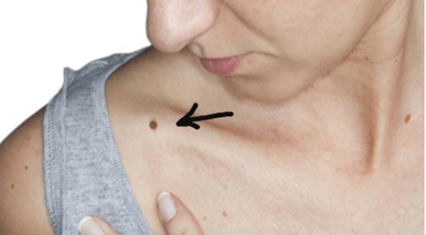 8 nốt ruồi cực xấu khiến bạn cả đời long đong, nghèo khổ 8 not ruoi cuc xau khien ban ca doi long dong, ngheo kho