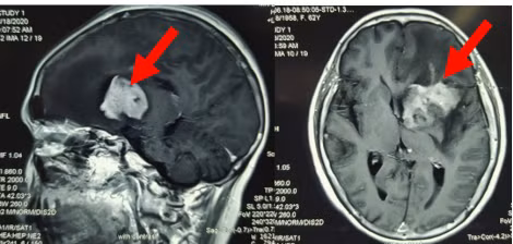 Phat hien u nao ac tinh hiem gap sau con dau dau dai dang