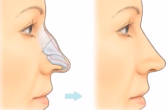 Mũi lộ xương, nổi gồ. Tước mũi lộ xương là mũi ít thịt, gầy, da mỏng, phần sống mũi lộ rõ. Người có tướng mũi này thường khá tham lam, ích kỷ, chỉ biết tới bản thân mình mà không suy nghĩ cho người khác. Không chỉ vậy, họ còn giỏi bày mưu tính kế, lòng dạ nham hiểm, luôn nghi ngờ người khác, đề cao cảnh giác với mọi người và sự việc, thậm chí có khuynh hướng dễ kích động. 