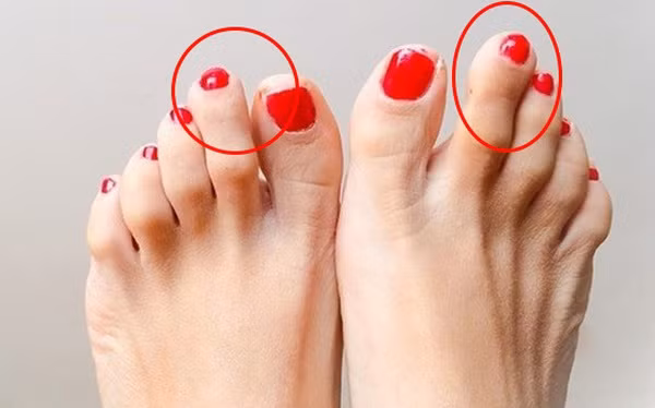 Ngón chân Hy Lạp. Nếu ngón chân thứ hai cao nhất, cao hơn cả ngón cái thì đây là kiểu ngón chân Hy Lạp, mang hình ngọn lửa. Nó cho thấy bạn là người luôn phải cố gắng hòa nhập với môi trường.