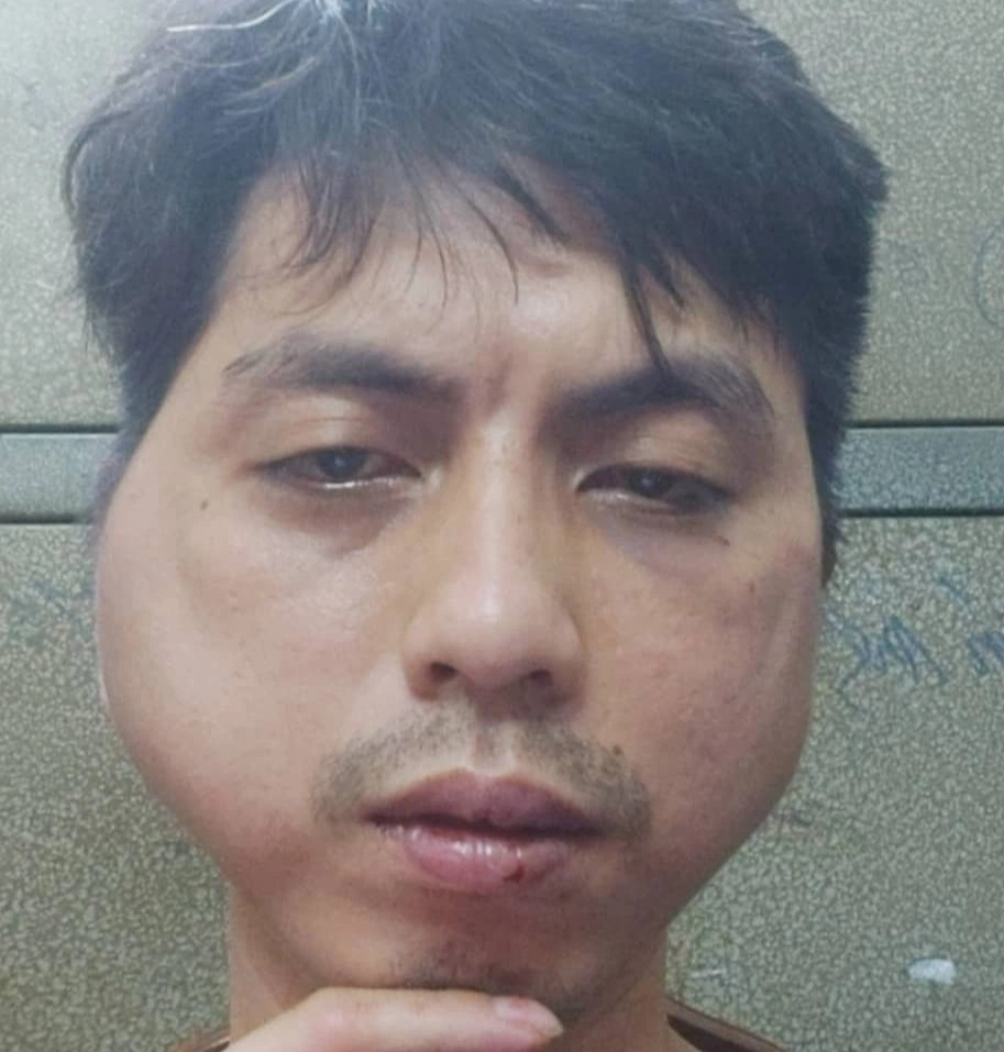 Thanh nien to bi chu quan lau nuong danh dap bien dang khuon mat