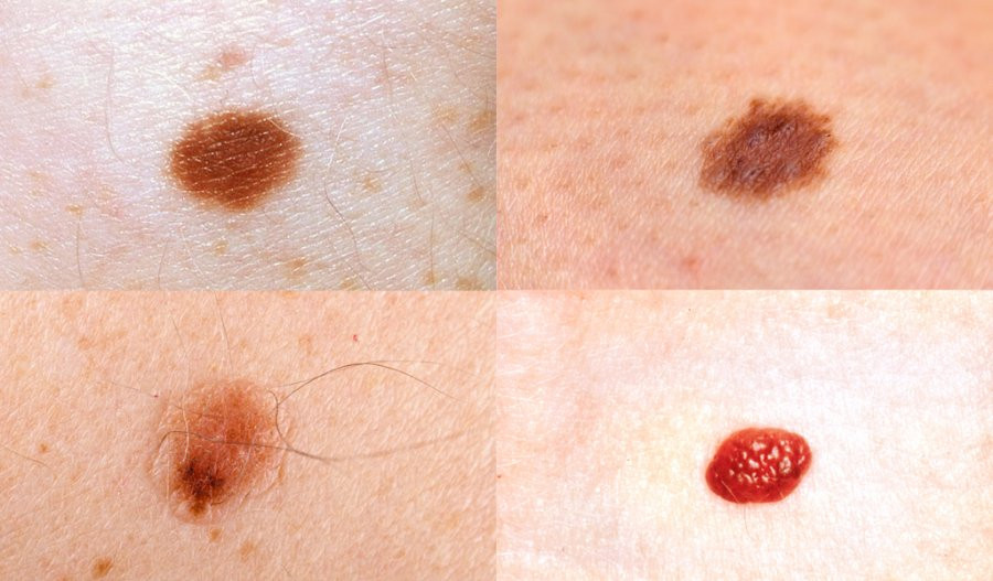 Not ruoi moc o 4 bo phan nay can de y ky