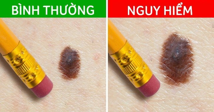 Not ruoi moc o 4 bo phan nay can de y ky-Hinh-5