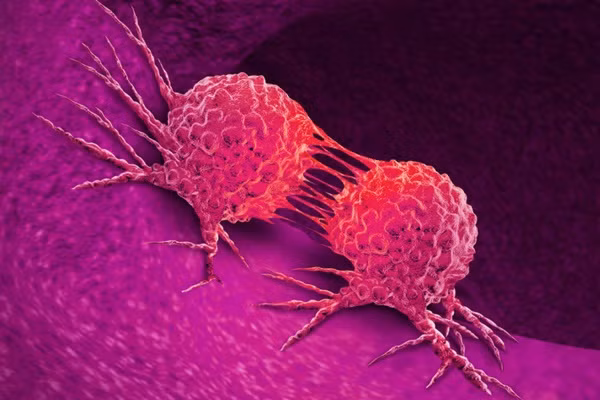 Nhieu nguoi nham can benh ung thu nay voi viem hong