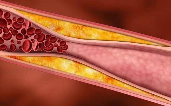 Mới 40 tuổi, mạch máu như ông cụ ngoài 70 tuổi ảnh 1