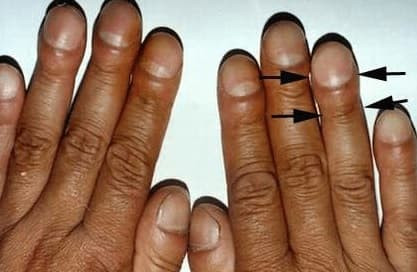  Ngón tay hình gậy, có đặc điểm là sưng mười ngón tay và thậm chí cả ngón chân, đầu ngóng tay dày hơn cuống ngón tay và có hình dạng giống như dùi trống. Đặc điểm này gặp ở nhiều loại bệnh phổi, chẳng hạn như bệnh phổi kẽ, giãn phế quản… Những người có tiền sử hút thuốc lá, nên đặc biệt cẩn thận về bệnh ung thư phổi.