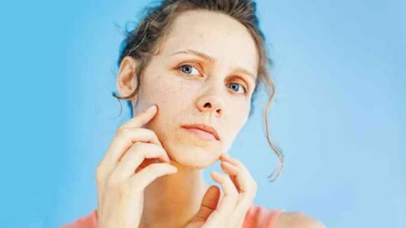 Mặt xanh, hai bên mặt nổi mụn là dấu hiệu rõ ràng của việc gan bị nhiễm độc. Vùng 2 bên mặt và bụng dưới là những nơi phản ánh sức khỏe của gan. Mỗi khi gan có bị nhiễm độc thì ở khu vực này sẽ phát ra các dấu hiệu cảnh báo bằng cách nổi mụn.