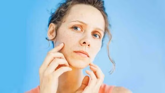 Mặt xanh, hai bên mặt nổi mụn là dấu hiệu rõ ràng của việc gan bị nhiễm độc. Vùng 2 bên mặt và bụng dưới là những nơi phản ánh sức khỏe của gan. Mỗi khi gan có bị nhiễm độc thì ở khu vực này sẽ phát ra các dấu hiệu cảnh báo bằng cách nổi mụn.