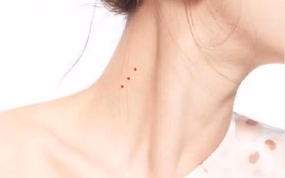 Lòng bàn tay đỏ và nốt ruồi đỏ trên cổ là dấu hiệu của bệnh xơ gan, nhiều bệnh nhân viêm gan B cuối cùng sẽ bị xơ gan, chức năng gan suy giảm sẽ dẫn đến sự tích tụ các hormone trong cơ thể, và các mao mạch ở lòng bàn tay và cổ sẽ nở ra, kéo theo sự phát triển của lông cọ. Trên cổ mọc nốt ruồi nhện đỏ và đỏ.