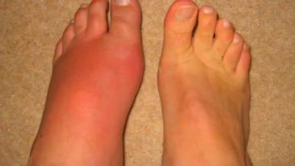 Chảy nước mắt và sưng bàn chân, ho lâu ngày và hen suyễn sẽ ảnh hưởng đến chức năng tim, thậm chí dẫn đến suy tim. Đặc điểm của những bệnh nhân này là mắt luôn chảy nước mắt và bàn chân sưng phù, hai là biểu hiện của suy hô hấp và suy tim.