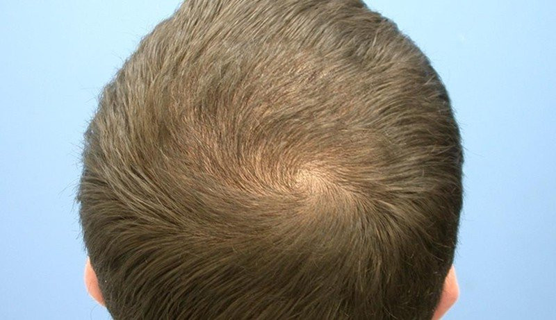 Nhìn xoáy tóc trên đầu đoán tính cách, vận mệnh của con Nhin xoay toc tren dau doan tinh cach, van menh cua con