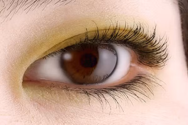 2. Lòng trắng ngả màu vàng. Được gọi là bệnh ban vàng, thường cảnh báo lượng cholesterol trong cơ thể cao hơn mức bình thường. Ngoài ra, triệu chứng này còn là lời cảnh báo bạn trước nguy cơ mắc phải các bệnh về tim mạch.