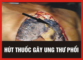 5. Hút thuốc lá gây ung thư phổi