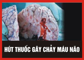3. Hút thuốc lá gây chảy máu não