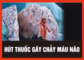 3. Hút thuốc lá gây chảy máu não