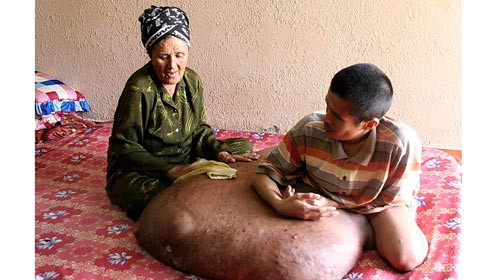 Anh Nguyễn Duy Hải lúc chưa phẫu thuật