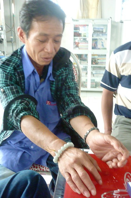 Anh Lương nay đã khỏi hẳn nhưng vết sẹo ở chân tay do bị xích vẫn còn in rõ.