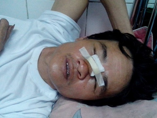 Ông Nghị với vết thương ở phần sống mũi
