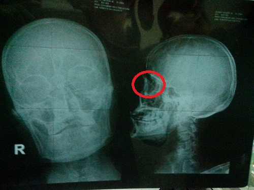 Hình ảnh tổn thương được thể hiện trên phim chụp của bệnh viện