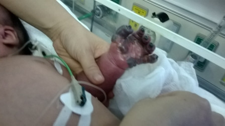 Cháu bé bị hoại tử tay sau tiêm phòng lao.