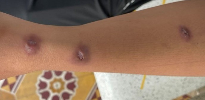 Mat nua nam chua vet u gai tom dam moi biet minh mac benh lao-Hinh-2