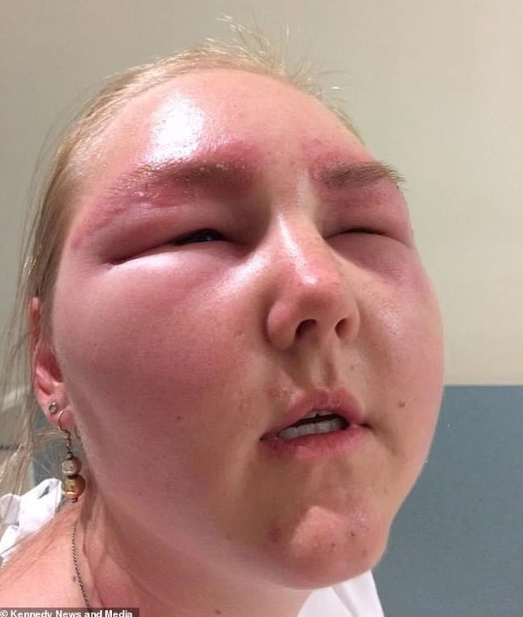 Co dau suyt bi mu vinh vien vi ham nhuom long may-Hinh-4