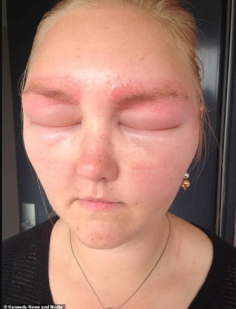 Co dau suyt bi mu vinh vien vi ham nhuom long may-Hinh-2