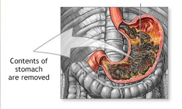 Neu ban co 5 trieu chung nay, hay di kiem tra da day ngay lap tuc