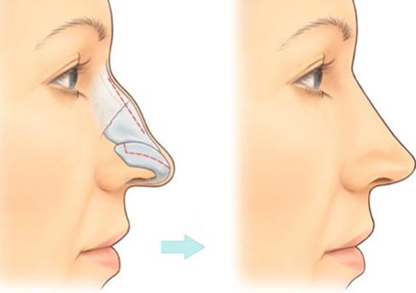 Sống mũi gồ, cong vẹo, lộ xương. Mũi là bộ phận tượng trưng cho năng lực cá nhân và khả năng nhận thức của một người. Xem tướng khuôn mặt, người mà mũi nhọn gầy lộ xương thì cả đời cô độc, tính tình cao ngạo nên rất khó hợp tác với người khác, cũng khắt khe khó tính, lại ích kỷ chỉ nghĩ cho mình nên ai nấy đều xa lánh.