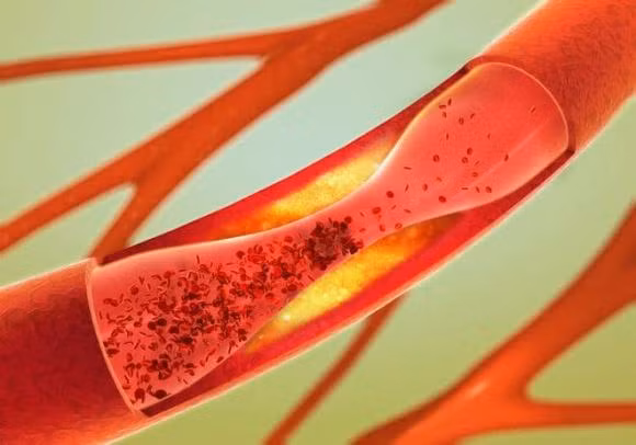 3 bieu hien bat thuong, co the la dau hieu cua tac nghen mach mau-Hinh-2