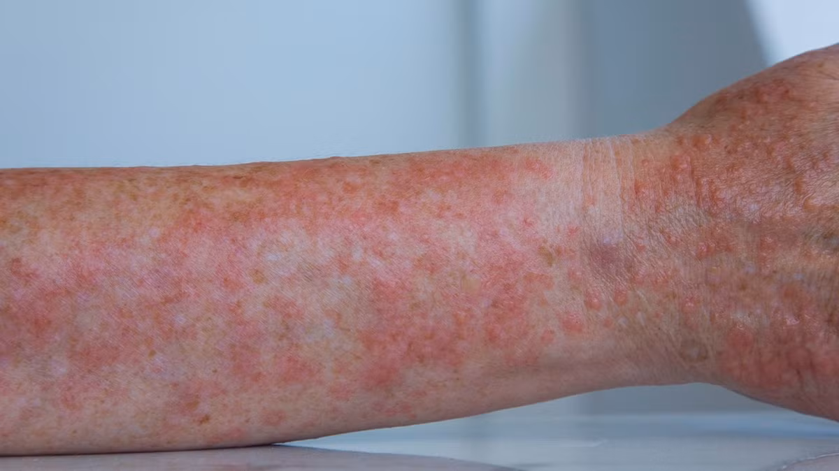 Nhung nguyen nhan khien chung ta noi man khi nang nong