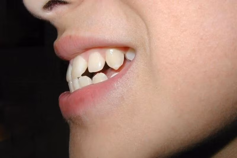 Chính vì vậy, nếu một người có tướng răng mọc mất trật tự, khấp khểnh thì chủ nhân là người cộc tính, dễ nóng giận và nổi cáu với người khác. Mỗi khi mất bình tĩnh họ dễ dàng vung lời thô tục, bất chấp tất cả để hả lòng hả dạ. Đến khi mọi chuyện đã qua, nhìn lại phụ nữ có hàm răng khấp khểnh sẽ thấy không còn ai bên cạnh mình. *Thông tin mang tính tham khảo, chiêm nghiệm.