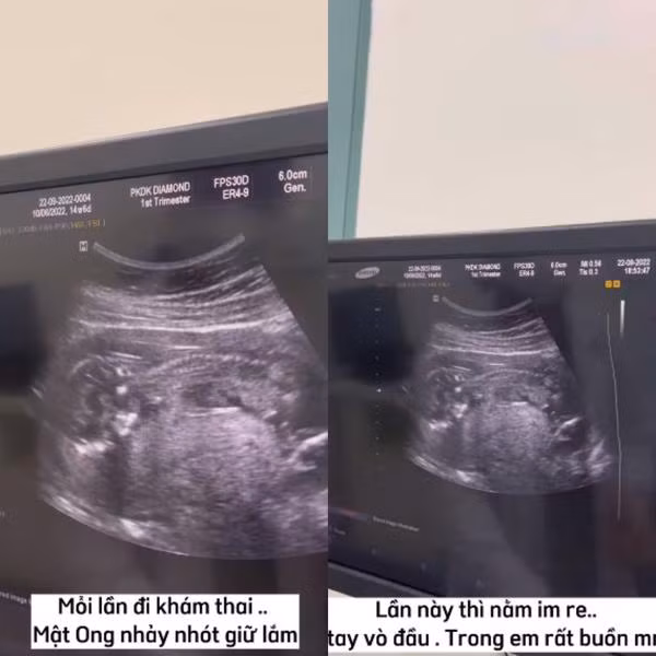 Chuan bi sinh con cho tomboy Bi Bao, Mui Xu lo anh khoc nuc no-Hinh-3