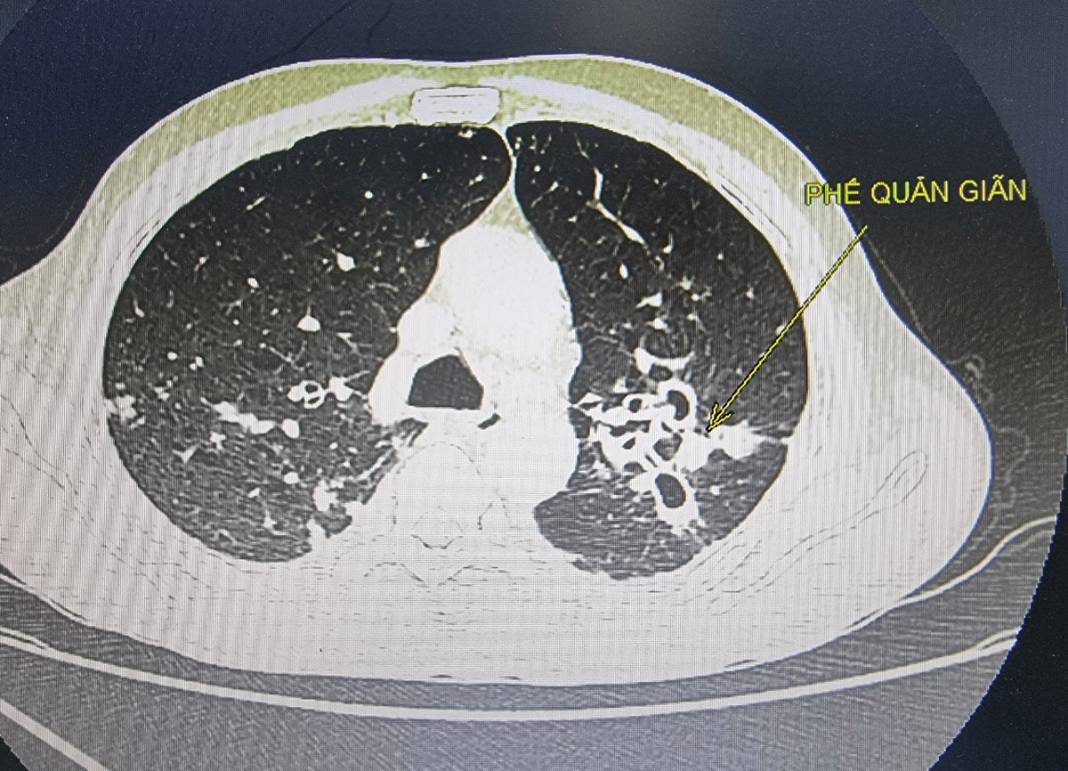 Thoi quen gay nguy co tu vong nhieu dan ong Viet biet van lam