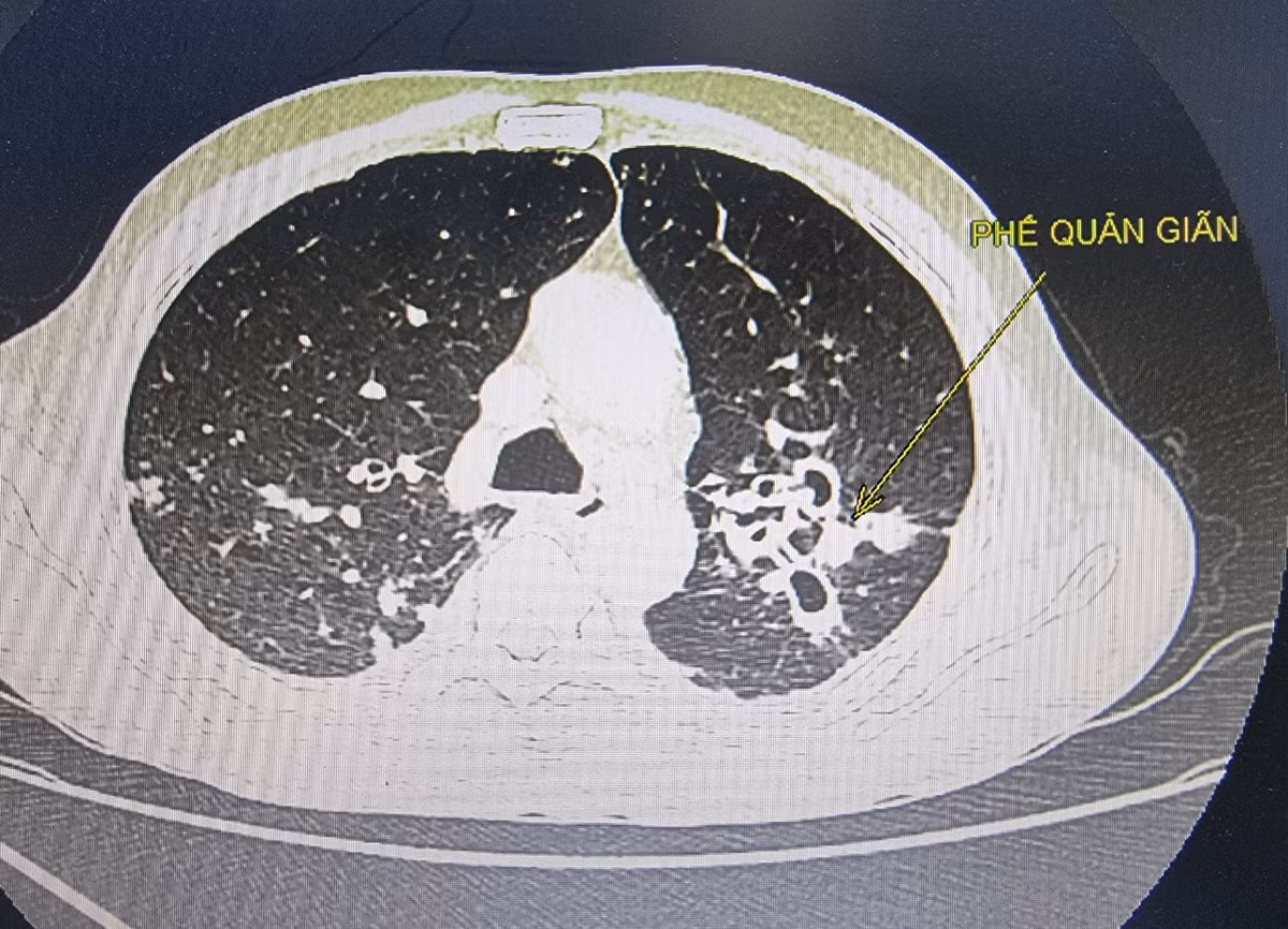 Thoi quen gay nguy co tu vong nhieu dan ong Viet biet van lam