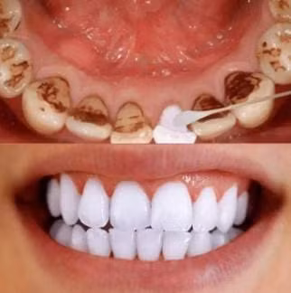 Bo 'thu nay' vao nuoc suc mieng, tra lai ham rang trang bong