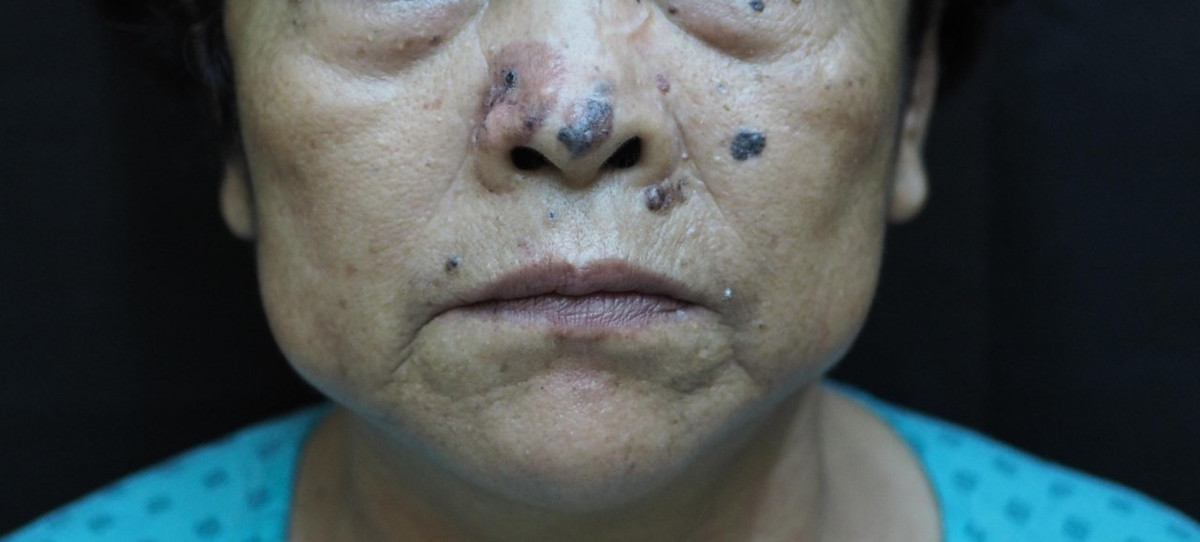 Ung thu thuong gap nhat o nguoi gia voi bieu hien rat quen thuoc