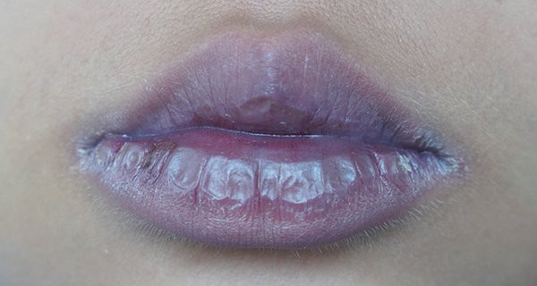 F0 nhiễm Omicron thấy dấu hiệu này trên môi cần cấp cứu ngay lập tức F0 nhiem Omicron thay dau hieu nay tren moi can cap cuu ngay lap tuc