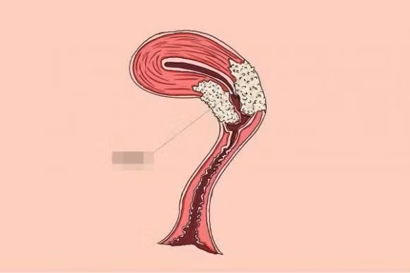 Phu nu khi di ve sinh hay de y neu co 3 dau hieu nay