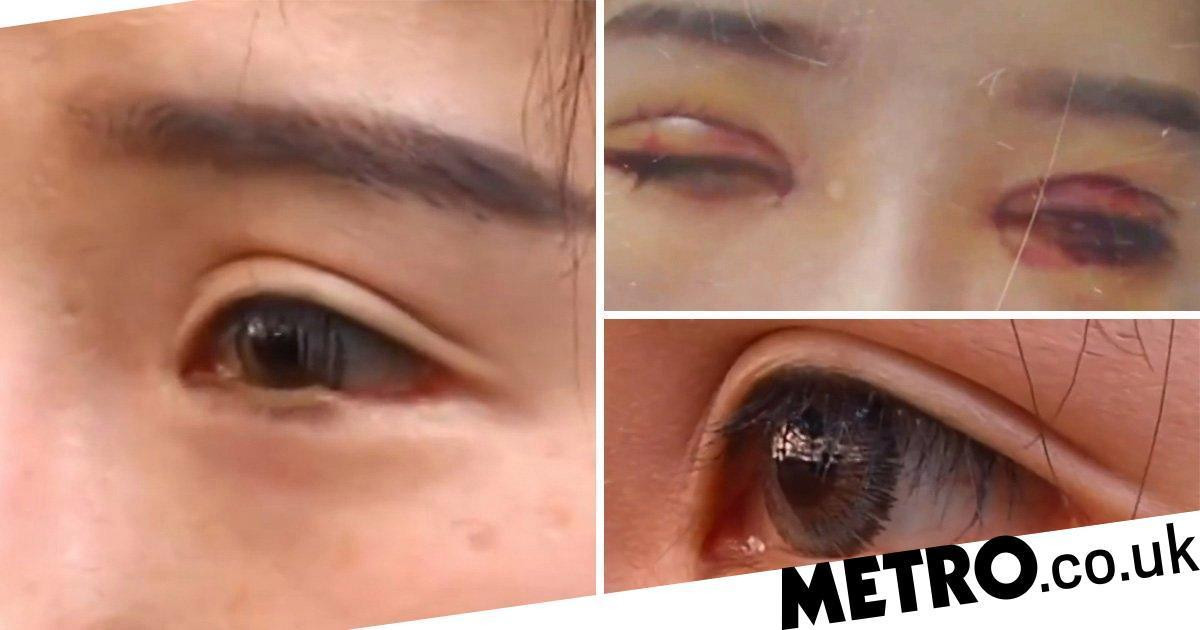 Phau thuat cho mat to ra, khong ngo bi lang bam cat mat mi mat