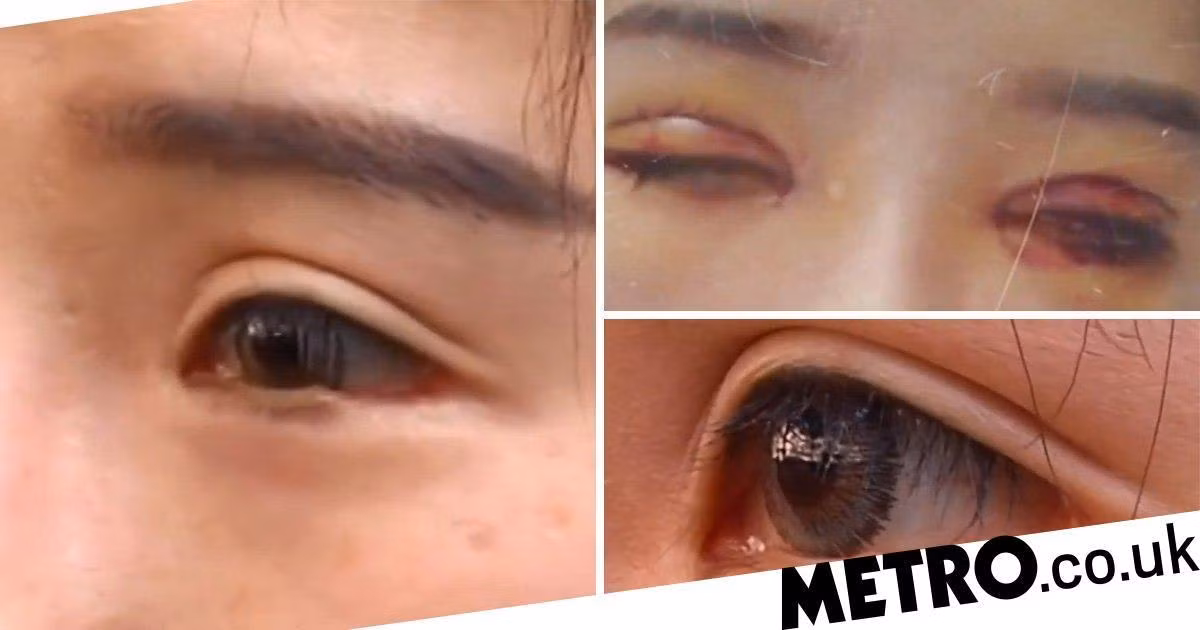 Phau thuat cho mat to ra, khong ngo bi lang bam cat mat mi mat